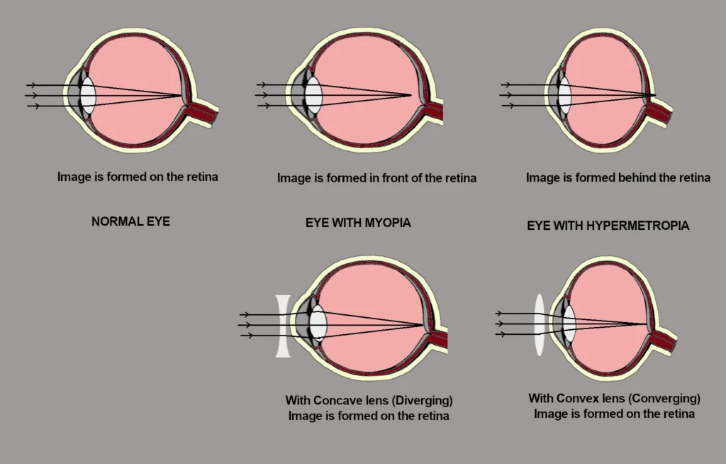 Human eye normal with myopia and Hypermetropia